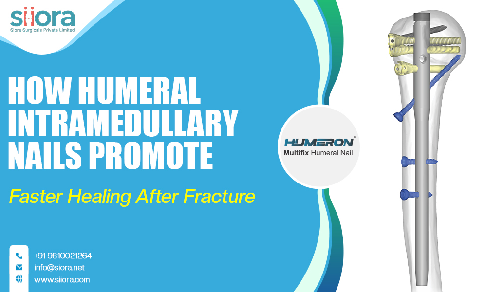 How Humeral Intramedullary Nails Promote Faster Healing After Fracture